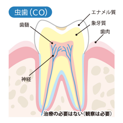 初期むし歯（CO）