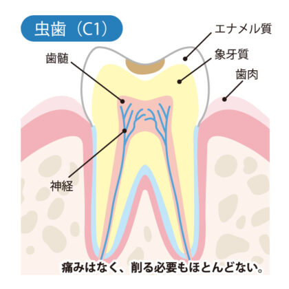 エナメル質のむし歯（C1