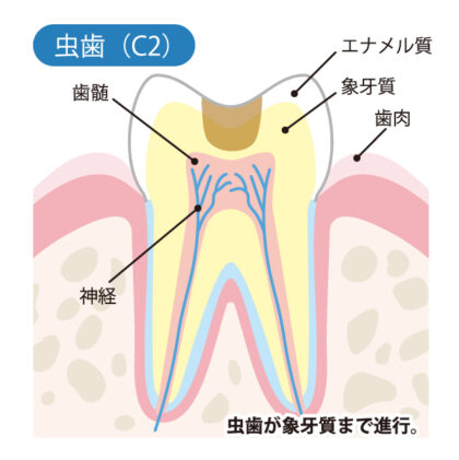 象牙質まで進んだむし歯（C2）