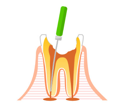 根管治療とは