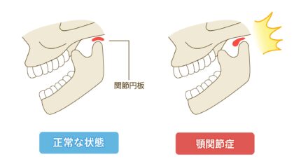 顎関節症とは