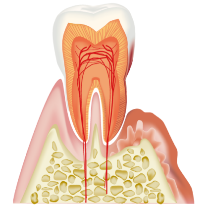 歯周病は早期発見・早期治療が重要