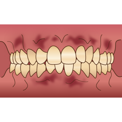 歯ぐきのホワイトニング「ガムピーリング」